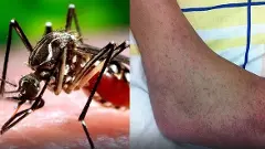 తెలంగాణలో చికున్‌గున్యా కేసులు, అమెరికా హెచ్చరిక జారీ