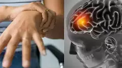 Hyderabad |హైదరాబాద్‌లో వెలుగుచూసిన జీబీఎస్ ఫస్ట్ కేసు, అలర్ట్